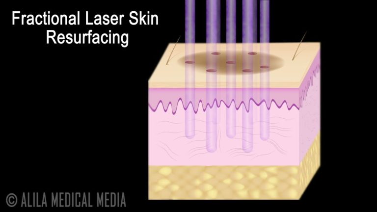 Laser Skin Treatment For Cosmetic And Medical Purposes