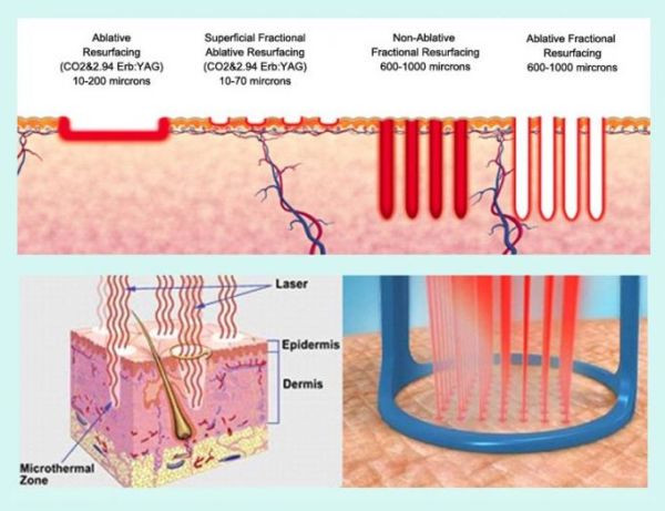 Laser Scar Treatment And Nonablative Techniques